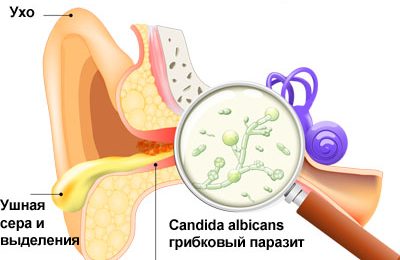 Ухо пловца и нарушение слуха Ухо пловца и нарушение слуха